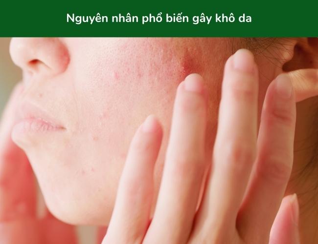 Khô da là tình trạng da bị mất nước gây nên tình trạng sần sùi, bong tróc da (Nguồn: RyanKing999)